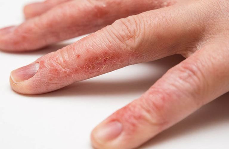 Các triệu chứng của bệnh tổ đĩa thường chỉ xuất hiện ở bàn tay, bàn chân còn hắc lào thì có thể xuất hiện khắp cơ thể