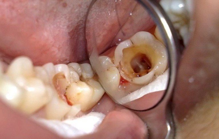 Sâu răng là một trong những nguyên nhân khiến răng bị ê buốt khi ăn đồ chua thường gặp