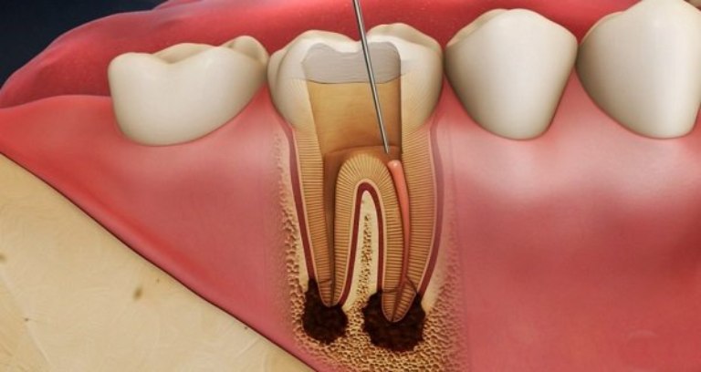 Viêm tủy răng có thể gây ra tình trạng buốt răng khi ăn đồ ngọt