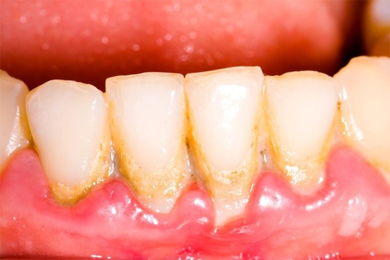 Sự tích tụ của mảng bám gây vôi răng có thể là nguyên nhân khiến răng bị ê buốt, nhạy cảm
