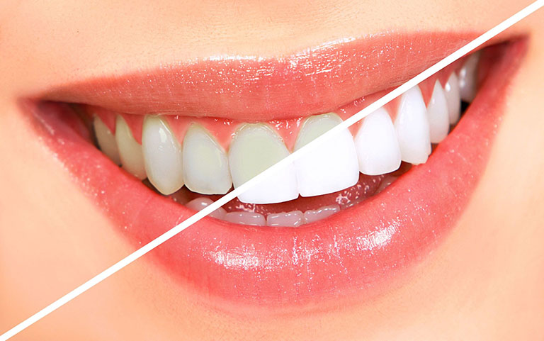 Cách giảm ê buốt răng khi tẩy trắng