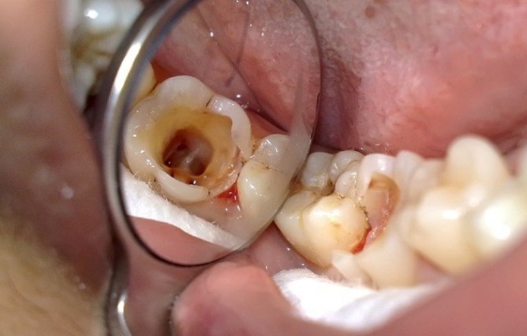 Khi bị sâu răng, bạn tốt nhất nên thăm khám nha khoa hoặc bác sĩ chuyên khoa để được điều trị