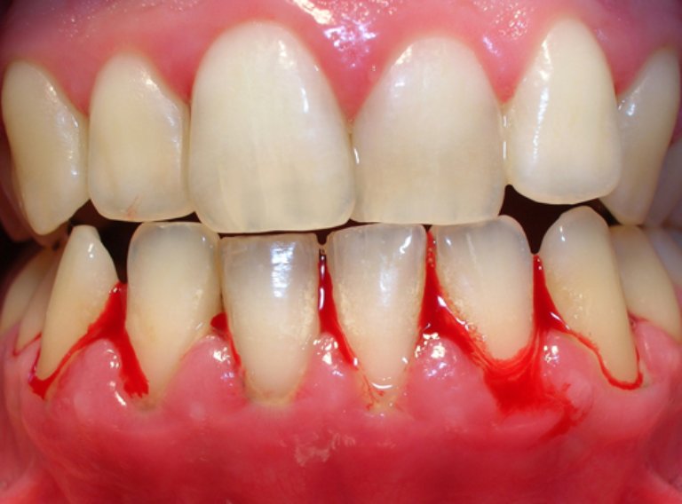 Viêm nướu răng cũng có thể là nguyên nhân gây đau nhức răng về đêm