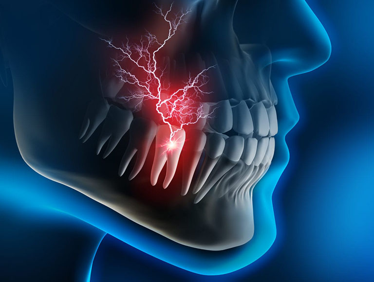 Viêm tủy răng hoặc các bệnh lý về răng miệng ở hàm có thể gây đau răng dẫn đến đau đầu