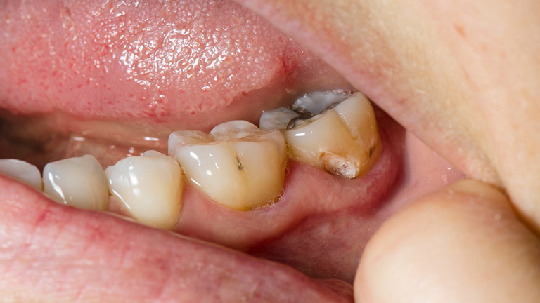Đau răng khi uống nước lạnh