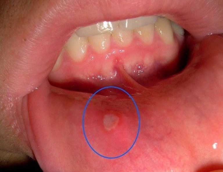 Thông thường các vết loét nhiệt miệng sẽ biến mất sau 7 - 10 ngày