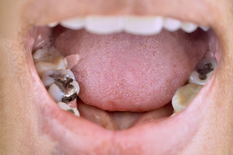 Răng bị ê buốt khi nhai