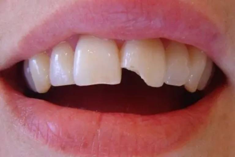 Răng mẻ bị ê buốt có thể do nhiều nguyên nhân gây ra