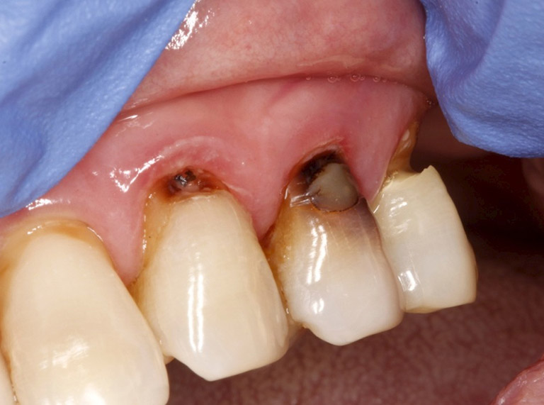 Sâu chân răng