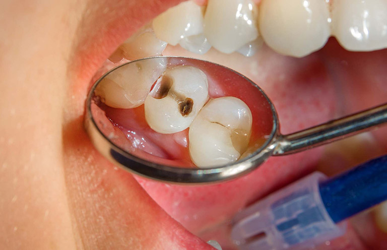 Sâu răng có tự khỏi được không?
