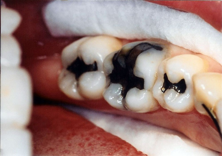 Sâu răng lan rộng
