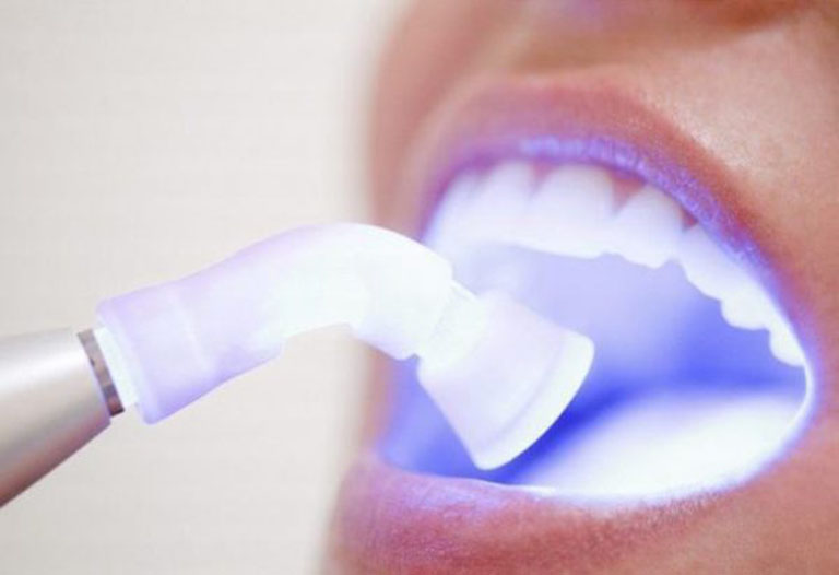 Tẩy trắng răng với đèn plasma