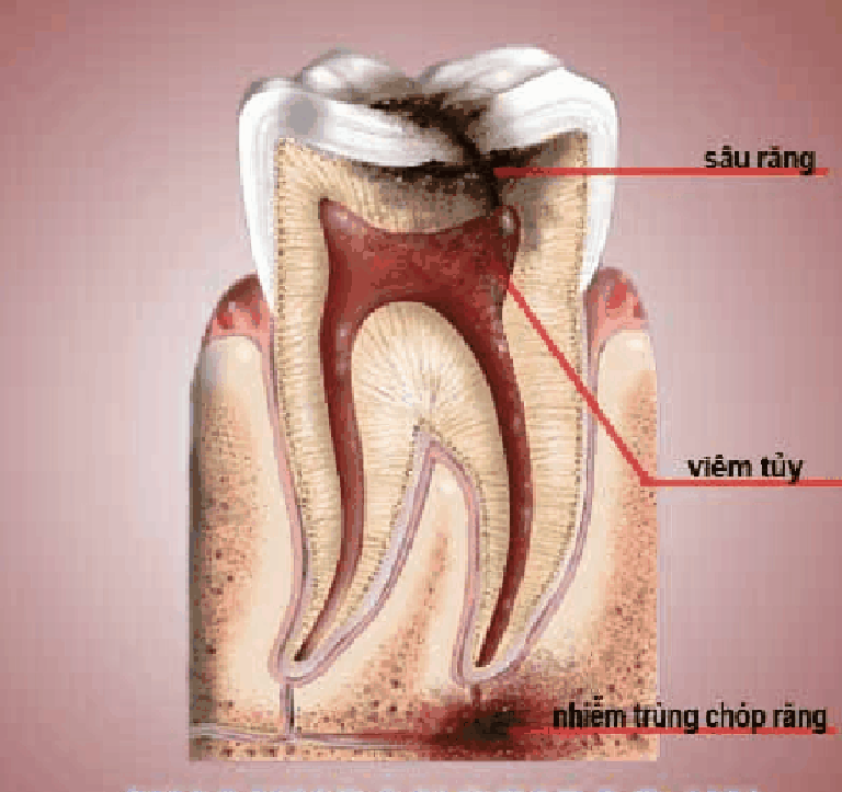 Các bệnh lý về răng