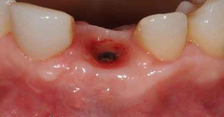 Viêm nha chu có mủ làm tăng nguy cơ mất răng
