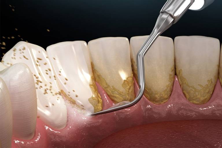 Lấy cao răng và xử lý mặt gốc răng