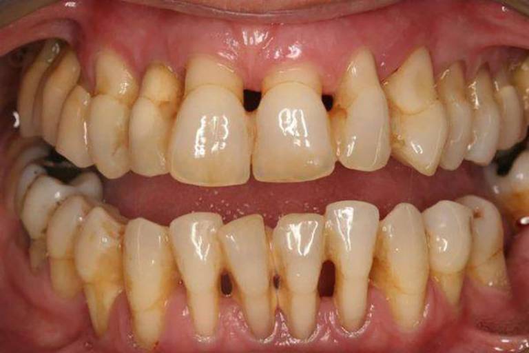 Nướu răng bị tụt để lộ chân răng