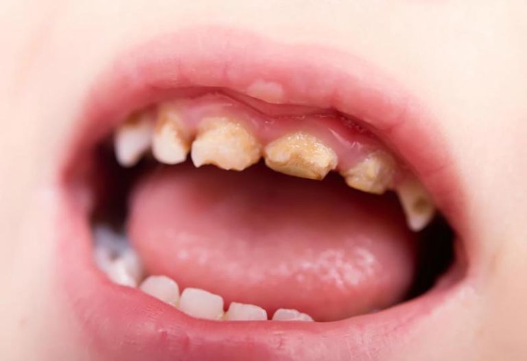 Viêm nha chu ở trẻ em là tình trạng viêm ở các tổ chức mô quanh răng