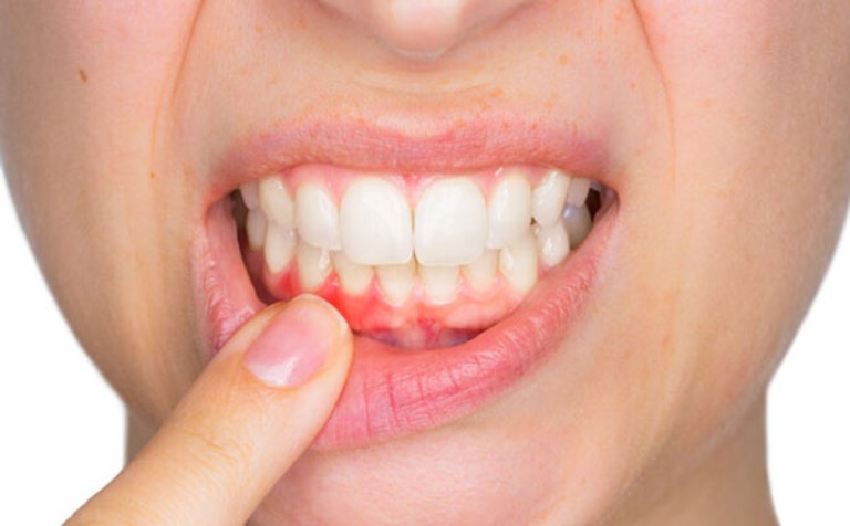 Viêm nướu chỉ gây tổn thương trên nướu răng còn viêm nha chu gây tổn thương tổ chức quanh răng
