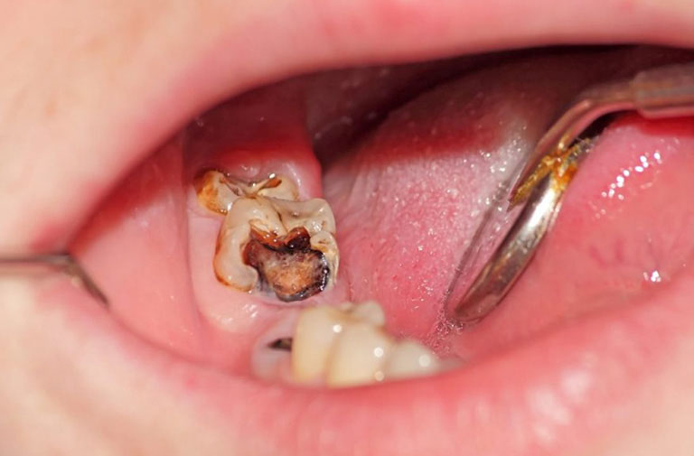 Sâu răng gây viêm tủy răng