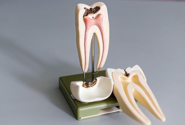 Viêm tủy răng có hồi phục và không hồi phục