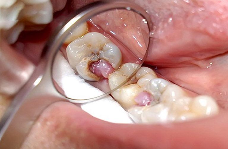 Viêm tủy răng có mủ không thể tự hồi phục mà phải có sự can thiệp chuyên môn