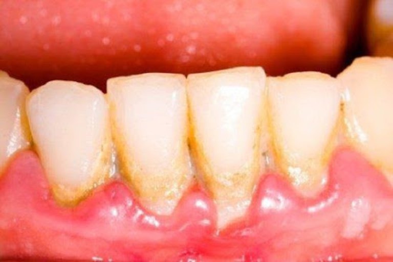 Bị viêm lợi có nên lấy cao răng không là thắc mắc chung của nhiều người