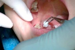 Đau sau khi nhổ răng là tình trạng thường gặp, hay kéo dài từ 3 - 5 ngày