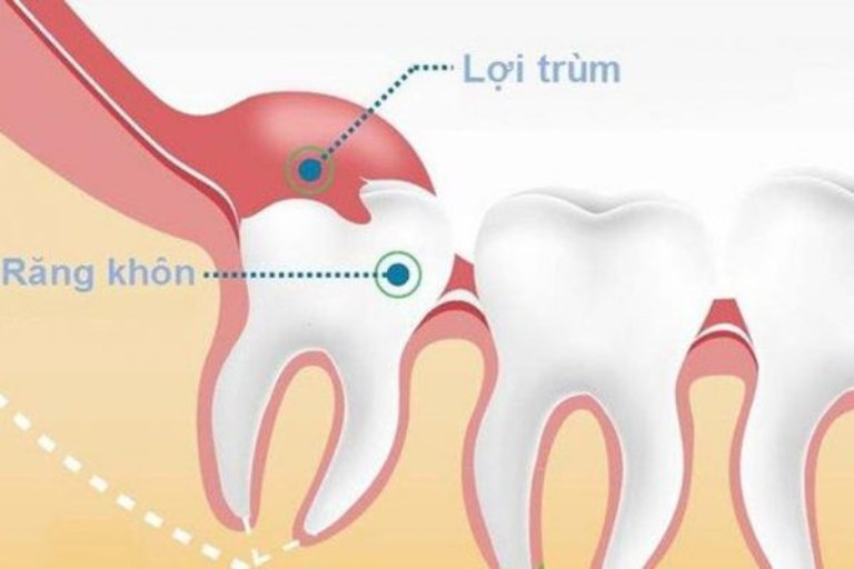 Lợi trùm răng khôn là tình trạng thường gặp có thể gây ra bệnh viêm lợi trùm hoặc viêm lợi trùm có mủ
