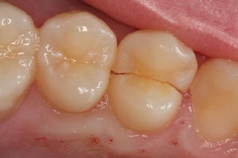Nứt răng cũng là một trong những nguyên nhân gây đau răng số 7 thường gặp