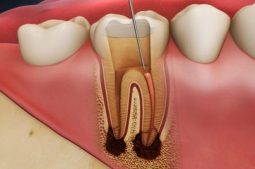 Diệt tủy răng thường được chỉ định cho trường hợp viêm tủy không hồi phục hoặc hoại tử tủy