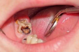 Lấy tủy răng là phương pháp điều trị thường được chỉ định cho trường hợp viêm tủy không hồi phục, hoại tử tủy