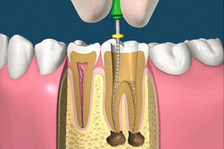 Tình trạng lấy tủy răng không sạch rất đáng lo ngại, có thể gây ra nhiều biến chứng nguy hiểm