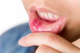 Nhiệt miệng mãn tính là tình trạng vết loét nhiệt miệng xuất hiện thường xuyên, nhiều lần trong năm
