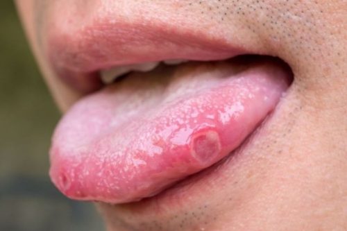 Nhiệt miệng ở lưỡi tương đối phổ biến, thường có liên quan đến nhiều yếu tố