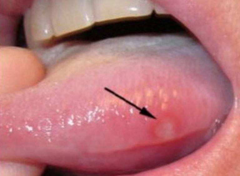 Dấu hiệu giúp chúng ta nhận biết nhiệt miệng ở lưỡi