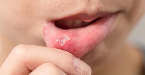 Bị nhiệt miệng tái đi tái lại nhiều lần gây ảnh hưởng nhiều đến sức khỏe và chất lượng cuộc sống của người bệnh