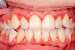 Tình trạng lợi sưng viêm tấy đỏ trong quá trình đeo mắc cài niềng răng