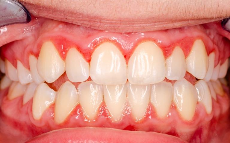 Tình trạng lợi sưng viêm tấy đỏ trong quá trình đeo mắc cài niềng răng
