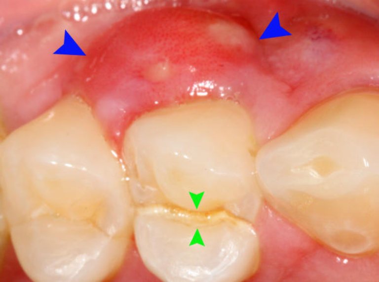 Sưng nướu răng có mủ có thể do nhiều nguyên nhân gây ra