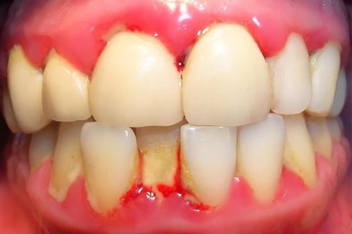 Sưng nướu răng cửa có thể do nhiều nguyên nhân gây ra