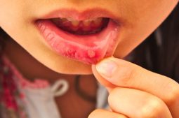 Trẻ hay bị nhiệt miệng thường có liên quan đến nhiều yếu tố