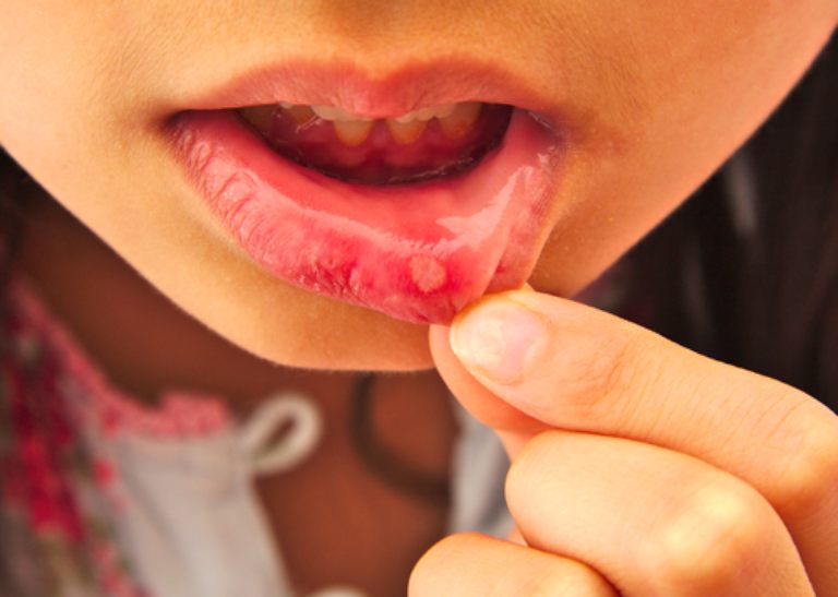 Trẻ hay bị nhiệt miệng thường có liên quan đến nhiều yếu tố