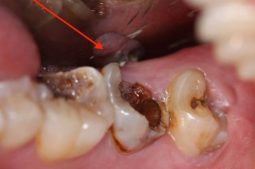 Tủy răng bị hoại tử là giai đoạn nghiêm trọng của bệnh viêm tủy răng không hồi phục