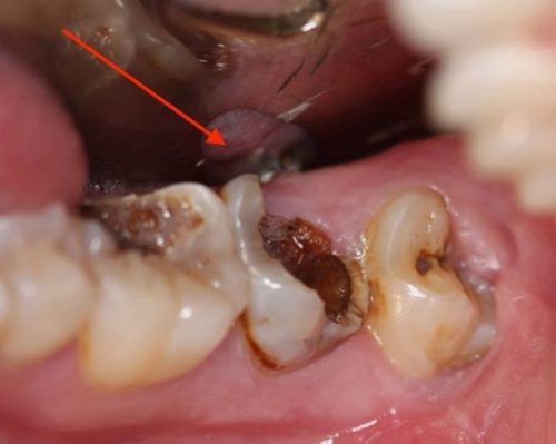 Tủy răng bị hoại tử là giai đoạn nghiêm trọng của bệnh viêm tủy răng không hồi phục