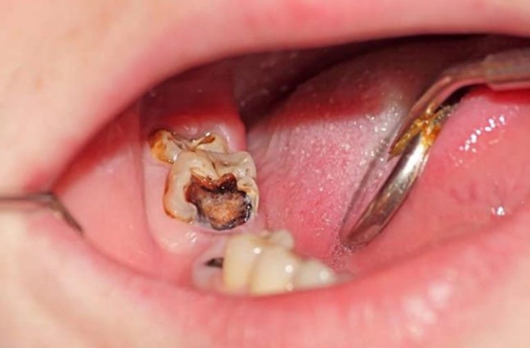 Viêm tủy răng mãn tính là nguyên nhân hàng đầu khiến tủy răng bị hoại tử 