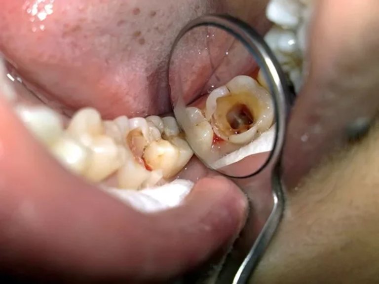 Tủy răng bị hoại tử rất nguy hiểm, cần sớm thăm khám để có biện pháp điều trị phù hợp