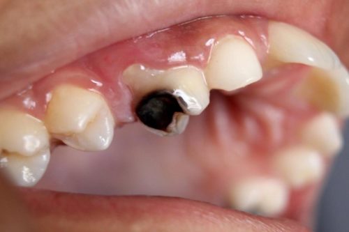 Tủy răng bị thối là tình trạng viêm nhiễm tủy nghiêm trọng khiến tủy bị hoại tử