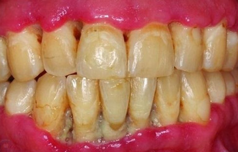 Viêm nha chu cũng có thể là nguyên nhân khiến tủy răng bị thối