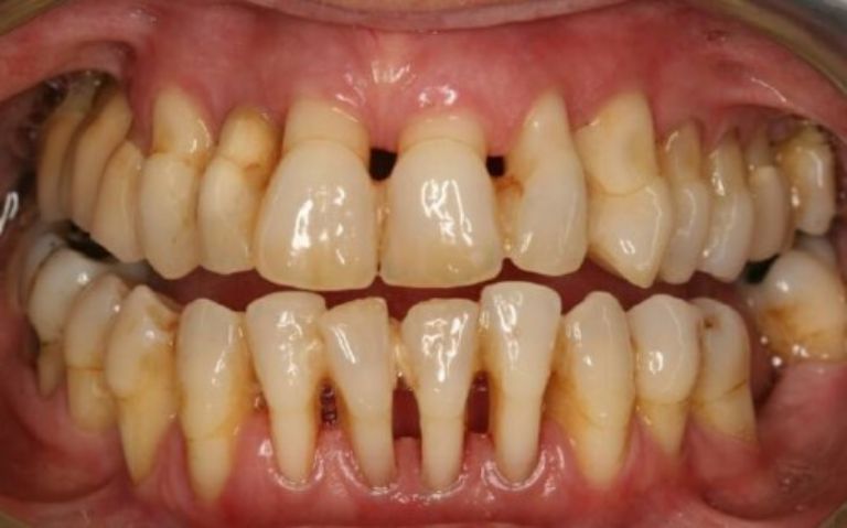Người mắc viêm nha chu nghiêm trọng sẽ không thể niềng răng được