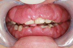 Viêm lợi phì đại là tình trạng lợi bị viêm nhiễm, mô nướu răng tăng sinh, phát triển quá mức